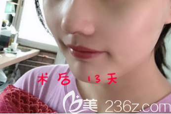 菏澤華美做假體隆鼻手術(shù)挺好的，并且菏澤華美做隆鼻的價(jià)格也不貴