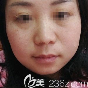 面診泰州麗都術前臉上有雀斑 面診泰州麗都術前臉上有雀斑
