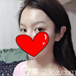 徐國建院長幫我做自體脂肪豐額頭術后額頭變飽滿 徐國建院長幫我做自體脂肪豐額頭術后額頭變飽滿