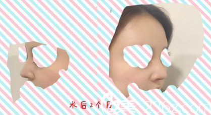 這些年我在德州做玻尿酸隆鼻積攢的一些經(jīng)驗(yàn)給大家，希望可以幫助到你們