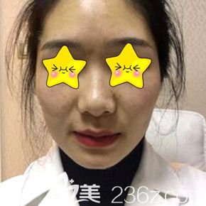 做面部脂肪填充術(shù)前照 做面部脂肪填充術(shù)前照