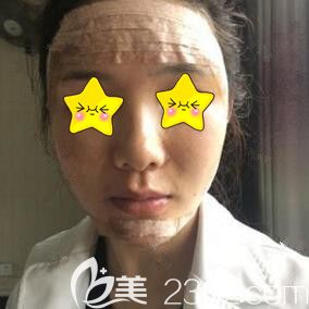 自體脂肪填充全臉術(shù)后第1天 自體脂肪填充全臉術(shù)后第1天