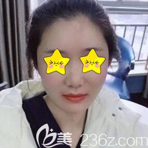 做自體脂肪填充面部術(shù)后一周恢復(fù)效果 做自體脂肪填充面部術(shù)后一周恢復(fù)效果