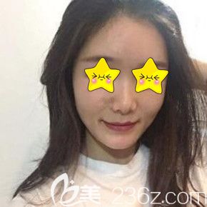 在長沙臉博士做自體脂肪填充面部術(shù)后20天恢復(fù)效果圖 在長沙臉博士做自體脂肪填充面部術(shù)后20天恢復(fù)效果圖