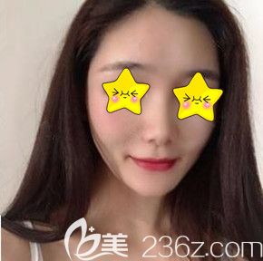 自體脂肪填充面部后臉會(huì)不會(huì)顯得很胖？用我找長(zhǎng)沙臉博士醫(yī)療美容唐永豐做全臉脂肪填充術(shù)后40天效果圖告訴你答案！