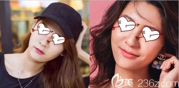 長春做脂肪填充哪家好?曬曬我在中妍整形找趙勝有院長做的自體脂肪全面部填充效果圖