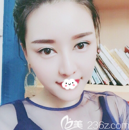 鼻綜合隆鼻術(shù)后15天效果圖 鼻綜合隆鼻術(shù)后15天效果圖