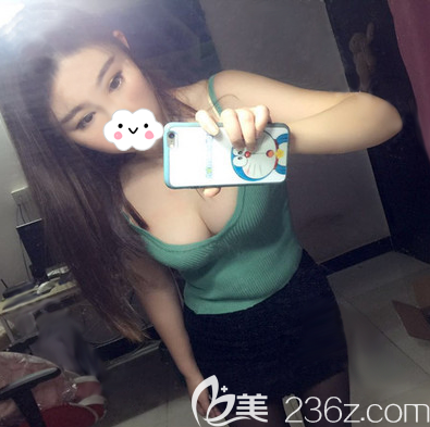 看到成都天姿（原恒博）李烈的自體脂肪豐胸案例，我專門從南京跑到成都做了豐胸手術(shù)