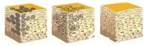 激光祛斑原理 激光祛斑原理