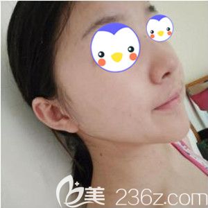 在元辰做脂肪填充術(shù)后1天效果圖 在元辰做脂肪填充術(shù)后1天效果圖