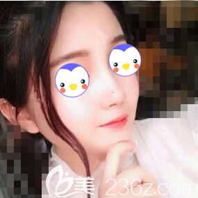 在沈陽元辰做自體脂肪填充面部術(shù)后5天效果圖 在沈陽元辰做自體脂肪填充面部術(shù)后5天效果圖