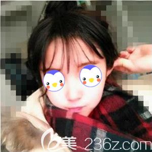 在沈陽做面部脂肪填充術(shù)后半個月效果圖 在沈陽做面部脂肪填充術(shù)后半個月效果圖