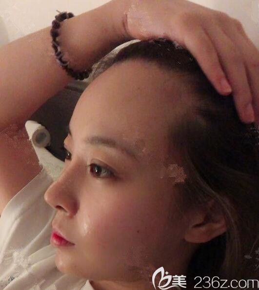 在韓國moplus文珉善做了切開法1800根發(fā)際線移植很自然，密度也滿意