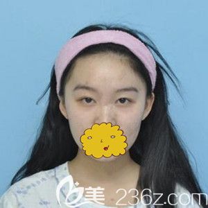 在沈陽做雙眼皮術(shù)前照 在沈陽做雙眼皮術(shù)前照