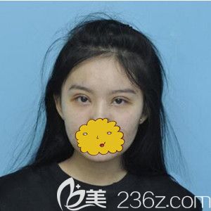 找孟強(qiáng)做雙眼皮術(shù)后6天恢復(fù)效果圖 找孟強(qiáng)做雙眼皮術(shù)后6天恢復(fù)效果圖