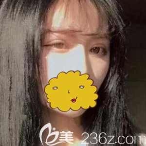 在沈陽騰采做雙眼皮術(shù)后22天恢復(fù)效果圖 在沈陽騰采做雙眼皮術(shù)后22天恢復(fù)效果圖