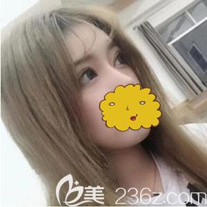 在沈陽騰采做雙眼皮術(shù)后40天效果圖 在沈陽騰采做雙眼皮術(shù)后40天效果圖