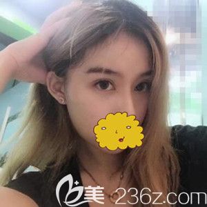 看我找沈陽騰采孟強(qiáng)做全切雙眼皮術(shù)后60天恢復(fù)效果圖大家覺得怎么樣？