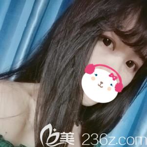 做埋線(xiàn)雙眼皮術(shù)后8天腫脹消失基本無(wú)出血