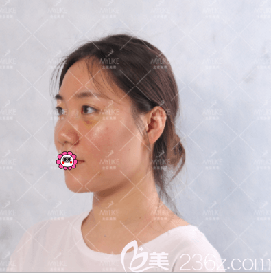 <!--<i data=20240703-sp></i>-->醫(yī)生給我做自體脂肪豐眼窩第3天樣子