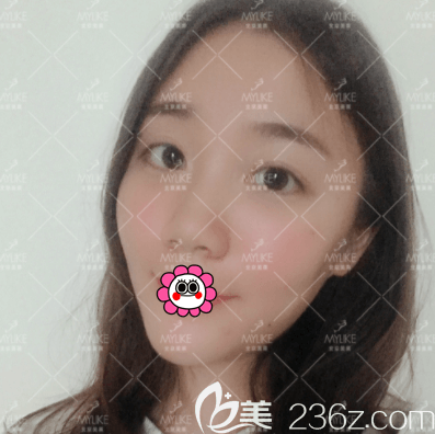 北京美萊自體脂肪豐眼窩案例