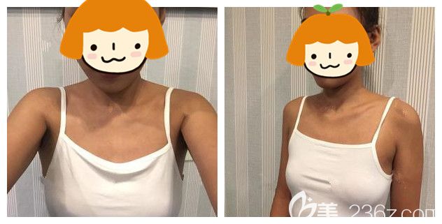 面診泰州麗都術(shù)前胸部較小 面診泰州麗都術(shù)前胸部較小