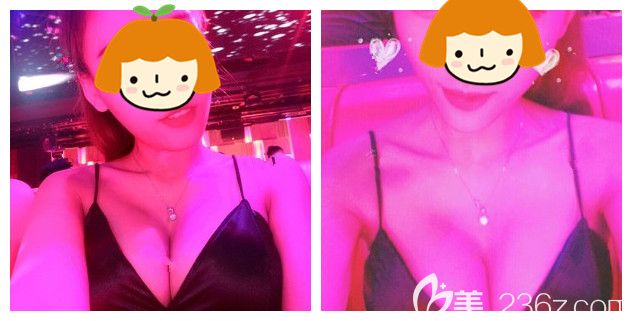 術(shù)后兩個月假體隆胸恢復情況 術(shù)后兩個月假體隆胸恢復情況