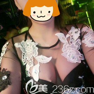 提前了解過威寧之星假體隆胸的報價、手感、使用年限才在泰州麗都做了220CC假體植入形狀真實手感柔軟