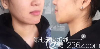 在德州做下頜角+顴骨術(shù)后第7天的樣子