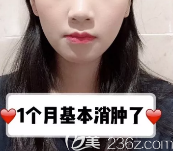 德州做下頜角+顴骨手術(shù)術(shù)后一個月