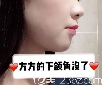 看吧！天生臉大的我在德州做了切除下頜角+顴骨手術(shù)，術(shù)后第7天我都開心了