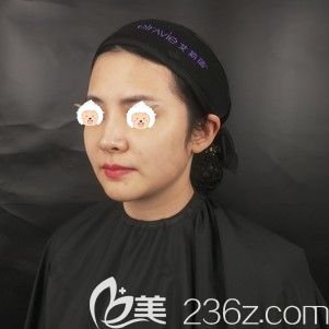 在武漢藝星做玻尿酸填充前面部凹陷的自己 在武漢藝星做玻尿酸填充前面部凹陷的自己