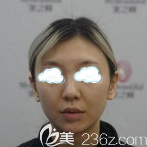 做面部埋線提升術(shù)前照 做面部埋線提升術(shù)前照