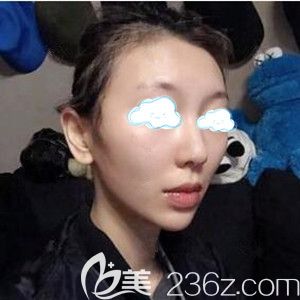 面部埋線提升術(shù)后1天效果圖 面部埋線提升術(shù)后1天效果圖