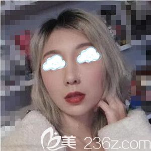 在美之峰做面部埋線提升術(shù)后9天照 在美之峰做面部埋線提升術(shù)后9天照