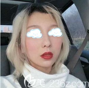 在長(zhǎng)沙做線雕術(shù)后半個(gè)月時(shí)的恢復(fù)效果圖 在長(zhǎng)沙做線雕術(shù)后半個(gè)月時(shí)的恢復(fù)效果圖