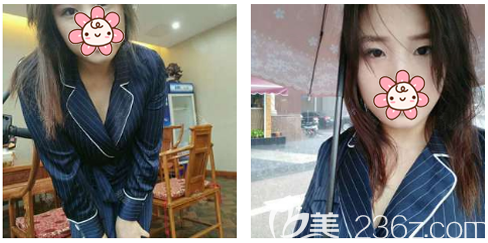 在廣州韓妃做隆胸術(shù)前照片 在廣州韓妃做隆胸術(shù)前照片