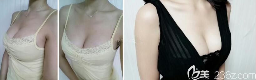 在韓國(guó)DA整形具賢國(guó)那做了水滴隆胸，效果真的好好再也沒人叫我太平公主了