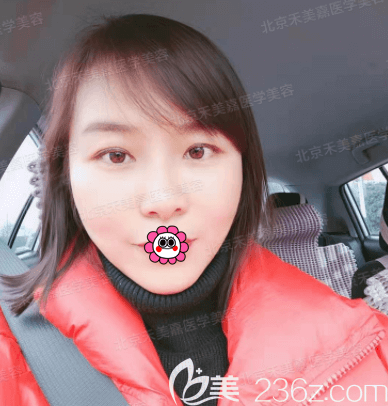 北京禾美嘉做面部脂肪加減法口碑好的任學(xué)會醫(yī)生真人案例