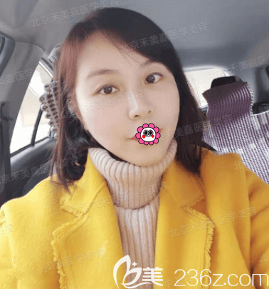 面部脂肪加減法多少錢?我花大幾萬(wàn)找北京禾美嘉任學(xué)會(huì)做面部脂肪加減法恢復(fù)圖奉上