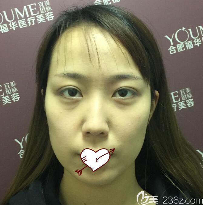 埋線提升+鼻綜合隆鼻術(shù)前照 埋線提升+鼻綜合隆鼻術(shù)前照