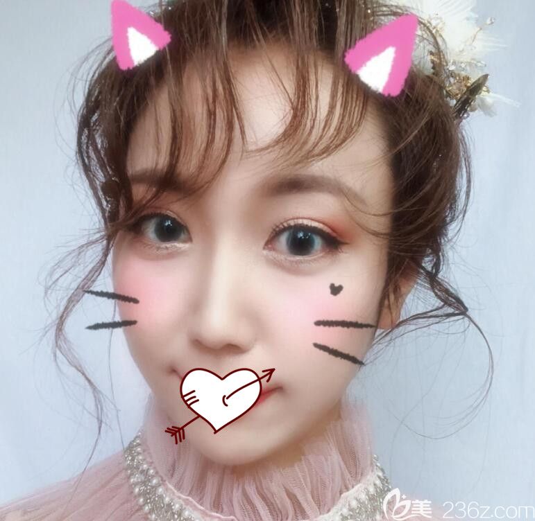 合肥福華整形鼻綜合+埋線術(shù)后第13天恢復(fù)情況 合肥福華整形鼻綜合+埋線術(shù)后第13天恢復(fù)情況