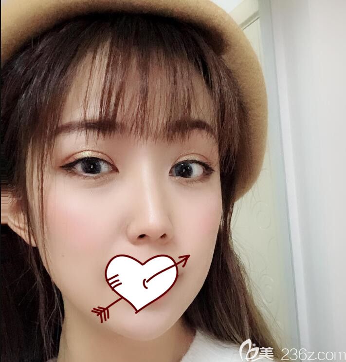 雖然找合肥福華整形做埋線提升全臉+鼻綜合還不到一個(gè)月，但是效果我是非常滿意滴