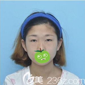 做雙眼皮修復(fù)術(shù)前照 做雙眼皮修復(fù)術(shù)前照