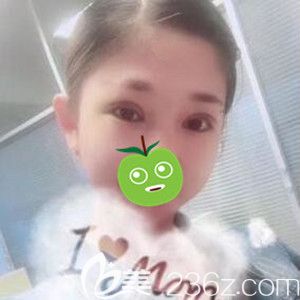 做雙眼皮修復(fù)術(shù)后6天效果圖 做雙眼皮修復(fù)術(shù)后6天效果圖