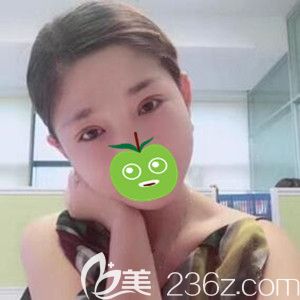 楊慶峰醫(yī)生修復(fù)雙眼皮真人術(shù)后16天照片 楊慶峰醫(yī)生修復(fù)雙眼皮真人術(shù)后16天照片