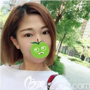 分享我找沈陽騰采醫(yī)療美容楊慶峰做雙眼皮修復(fù)術(shù)后60天恢復(fù)效果圖！