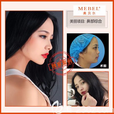 在南京美貝爾做鼻綜合案例