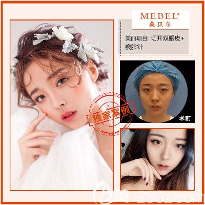 在南京美貝爾做雙眼皮案例
