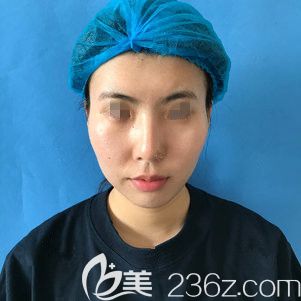面診泰州麗都術前面頰凹陷 面診泰州麗都術前面頰凹陷